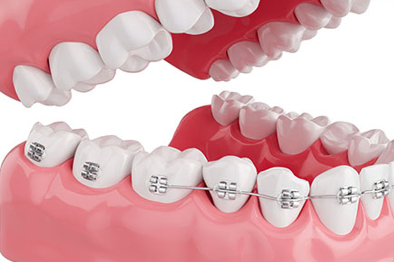 Ortodonti Tedavileri Antalya