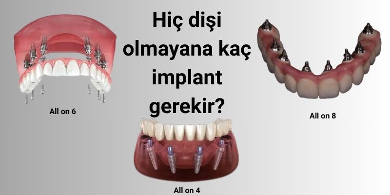 Hiç Dişi Olmayana Kaç İmplant Gerekir? Hiç Dişi Olmayana Kaç İmplant Gerekir? - Antalya
