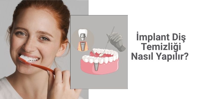İmplant Diş Temizliği Nasıl Yapılır? İmplant Diş Temizliği Nasıl Yapılır? - Antalya