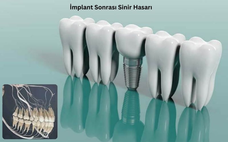 İmplant sonrası sinir hasarı- Antalya