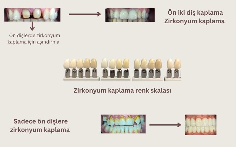 Sadece ön dişlere zirkonyum kaplama Antalya